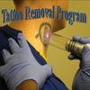 Tattoo Removal Program (Click to display link above)