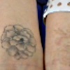 Tattoo Removal (Click to display link above)